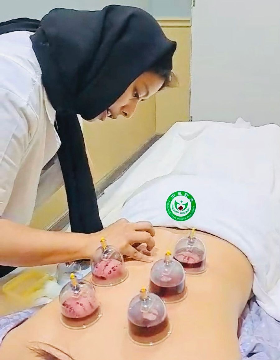 Cupping